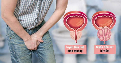 10 cách chữa viêm tiền liệt tuyến hiệu quả