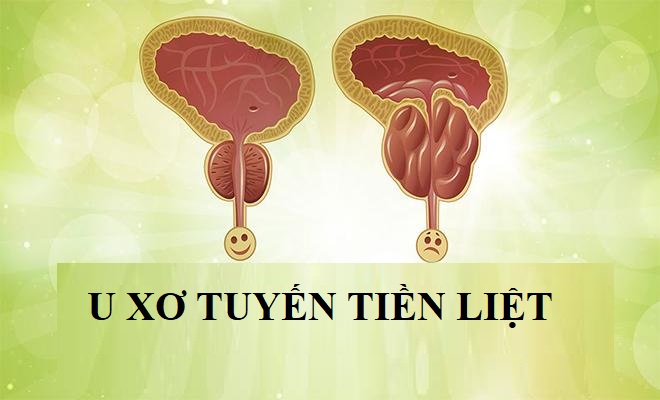 Mẹo chữa u xơ tiền liệt tuyến bằng thuốc nam hiệu quả