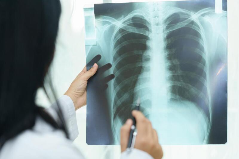 Bệnh xơ phổi có chữa được không? Nguyên nhân và cách điều trị bệnh xơ phổi