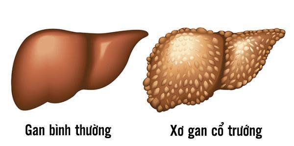 Xơ gan mất bù sống được bao lâu? Triệu chứng phổ biến là gì?