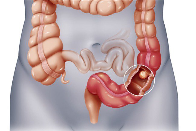 Trĩ nội độ 2 có tự khỏi không? Điều trị trĩ nội độ 2 như nào?