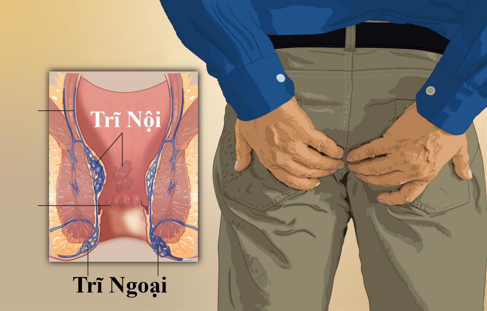 Top 7 cách phòng bệnh trĩ đơn giản hiệu quả