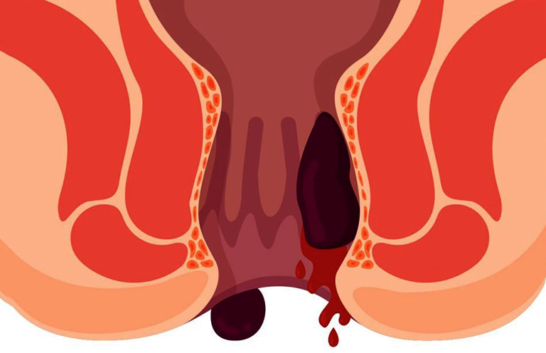 Bệnh trĩ ngoại độ 4 nguy hiểm như nào? Tìm hiểu ngay để biết