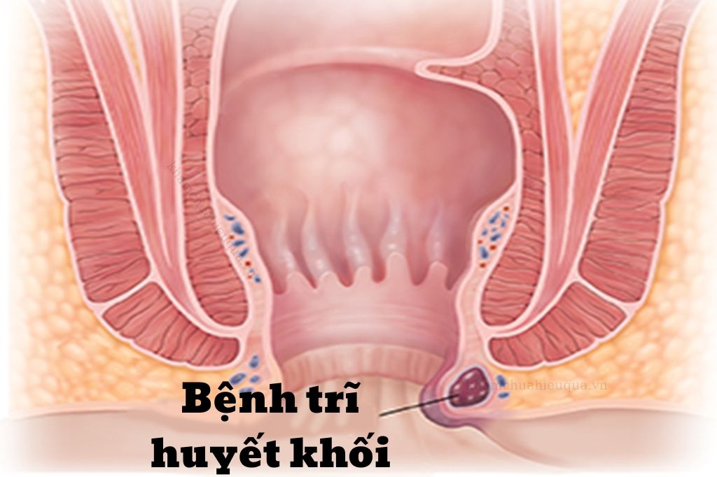 Bệnh trĩ để lâu có sao không? 5 biến chứng nguy hiểm nếu không điều trị bệnh trĩ