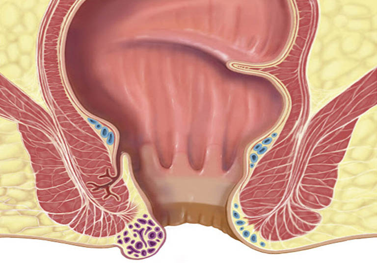 Bệnh trĩ có mấy cấp độ? 4 cấp độ nguy hiểm của bệnh trĩ nội và trĩ ngoại.