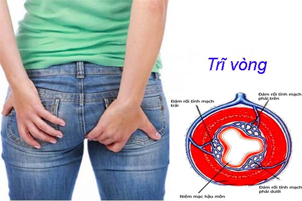 Cách phòng bệnh trĩ vòng hiệu quả bạn nên biết