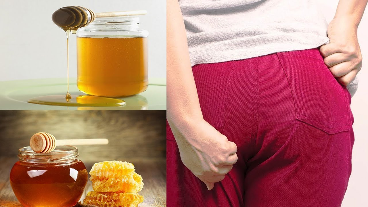Mách bạn 5 cách chữa bệnh trĩ bằng mật ong hiệu quả