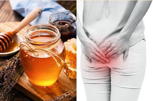Mách bạn 5 cách chữa bệnh trĩ bằng mật ong hiệu quả