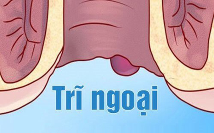 Dấu hiệu cảnh báo bệnh trĩ ở nữ giới mà chị em nên biết