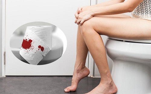 Trĩ nội độ 2 có tự khỏi không? Điều trị trĩ nội độ 2 như nào?