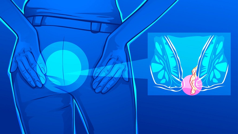 Trĩ hỗn hợp độ 3 có nguy hiểm không? Cần lưu ý gì khi bị trĩ hỗn hợp?