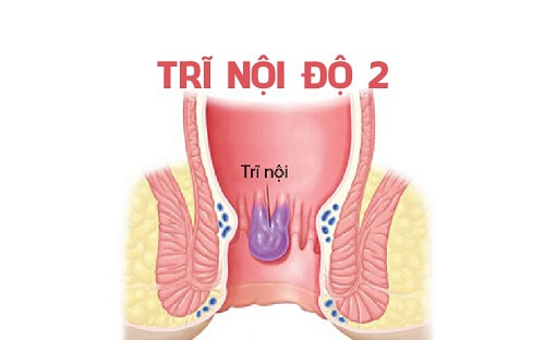 Trĩ nội độ 2 có tự khỏi không? Điều trị trĩ nội độ 2 như nào?