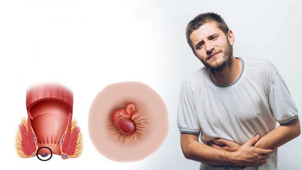 Trĩ ngoại độ 3 gây ra những biến chứng gì? Có cần phẫu thuật không?