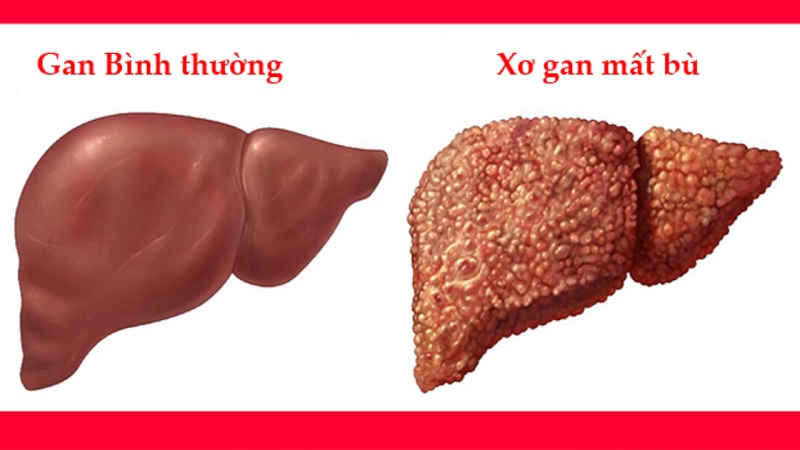 Xơ gan mất bù sống được bao lâu? Triệu chứng phổ biến là gì?