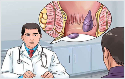 Búi trĩ có mủ là gì? Cách chữa bệnh trĩ có mủ hiệu quả