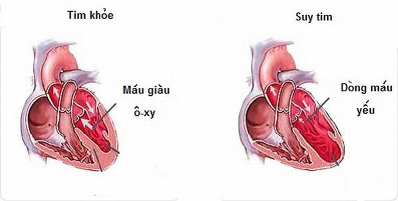 Bệnh suy tim độ 1 có nguy hiểm không? Tìm hiểu ngay để biết