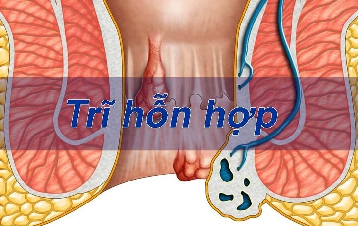 Trĩ hỗn hợp độ 4 gây ra những nguy hiểm gì?