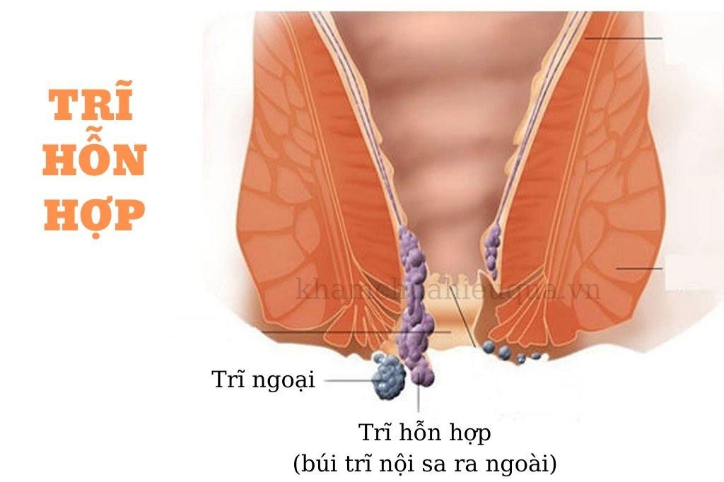 5 dấu hiệu cảnh báo bạn đã mắc bệnh trĩ hỗn hợp