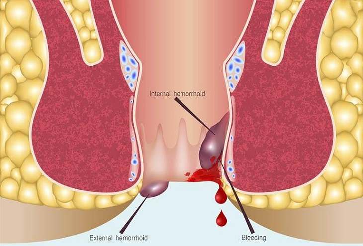 Trĩ nội chảy máu nguy hiểm như nào? Cách xử lí khi trĩ nội bị chảy máu