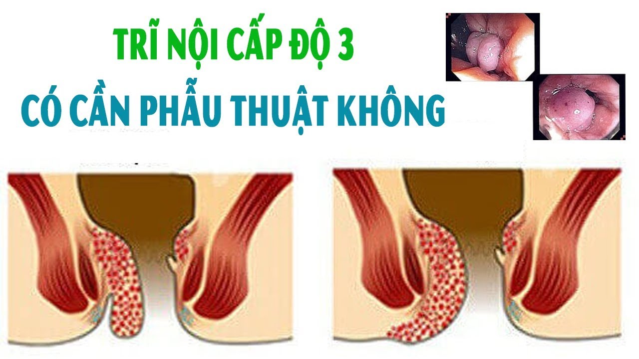 Bệnh trĩ nội độ 3 có cần phẫu thuật không?