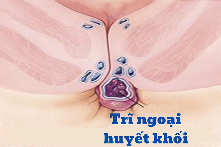 Dấu hiệu nhận biết trĩ huyết khối và cách điều trị hiệu quả