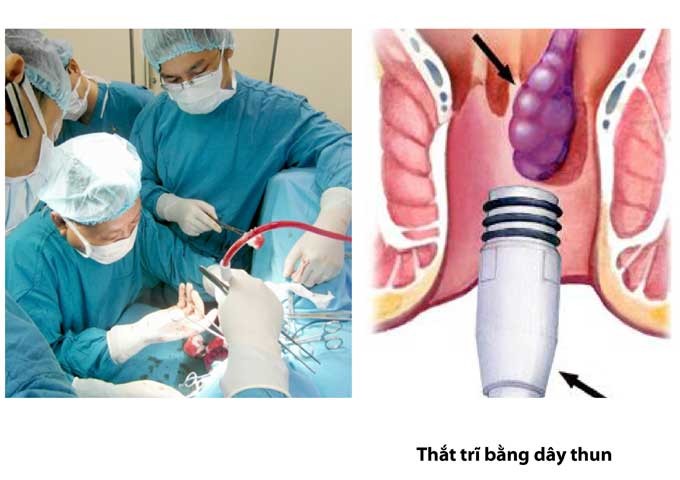 Khi nào nên phẫu thuật trĩ? Có nên cắt mổ trĩ không?