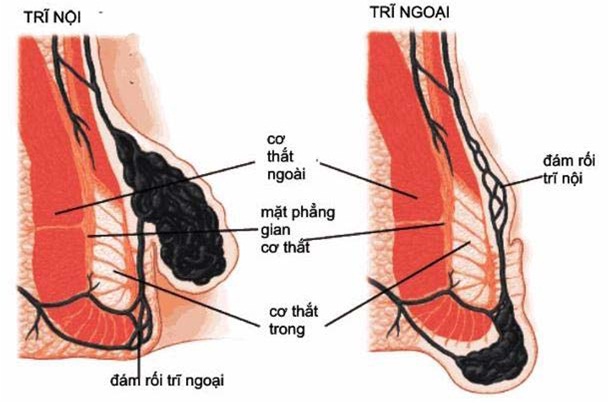 Khi nào nên phẫu thuật trĩ? Có nên cắt mổ trĩ không?