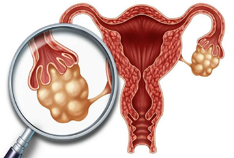 Dấu hiệu ung thư buồng trứng giai đoạn đầu mà chị em không nên chủ quan
