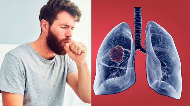 Ung thư phổi giai đoạn đầu: Làm sao để nhận biết?