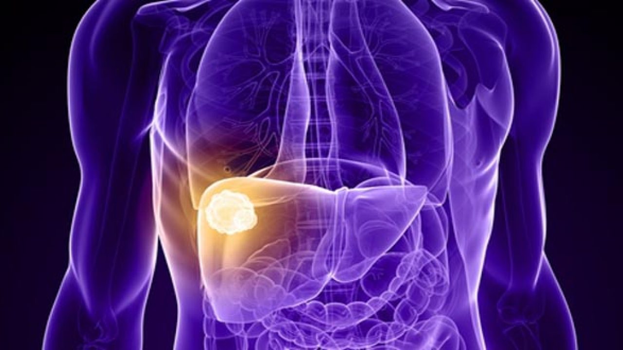 Nhận biết ngay 6 dấu hiệu ung thư gan trước khi quá muộn 