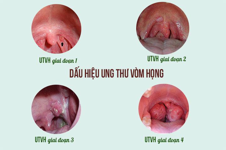6 dấu hiệu của ung thư vòm họng giai đoạn đầu, có thể bạn chưa biết