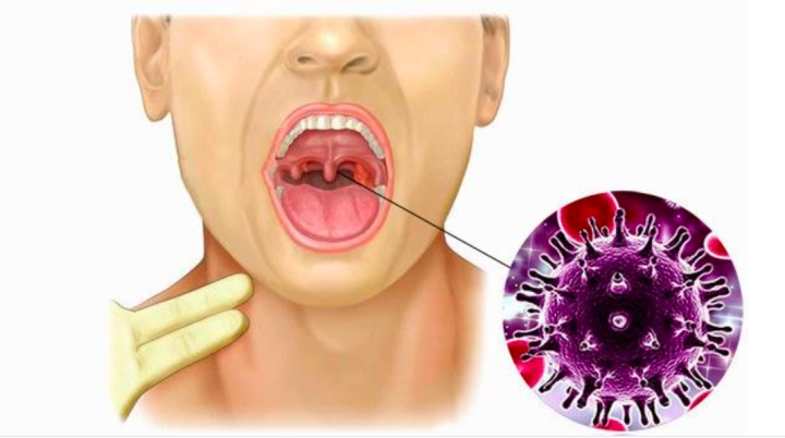 Một số yếu tố tiềm ẩn gây ung thư vòm họng, tuyệt đối không nên chủ quan.