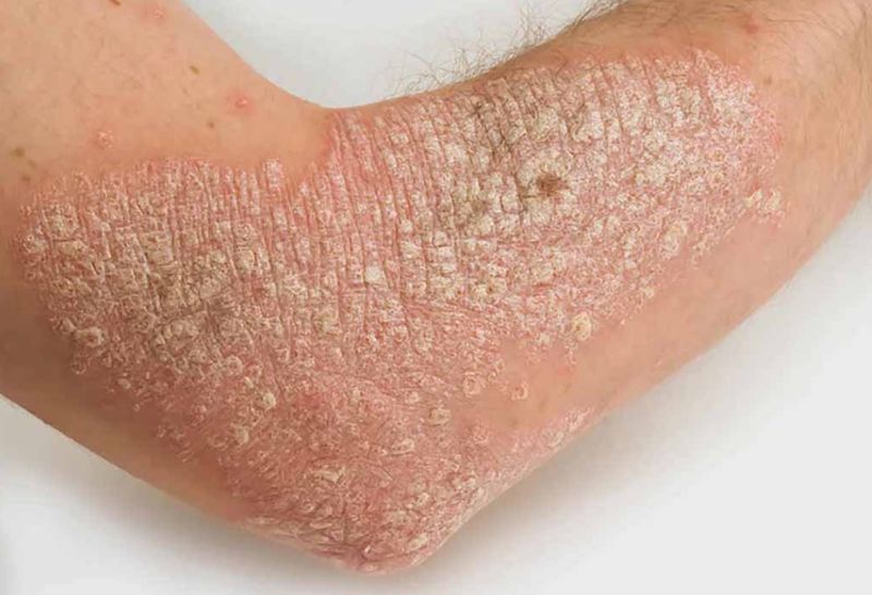 Cảnh báo 8 dấu hiệu ung thư da bạn cần lưu ý