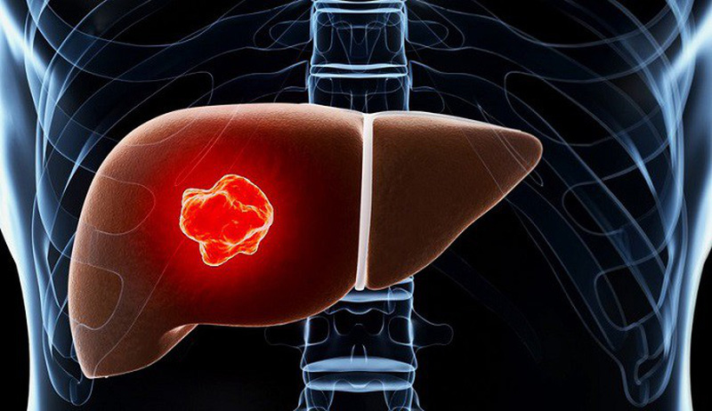 9 dấu hiệu cảnh báo ung thư gan giai đoạn đầu bạn tuyệt đối đừng nên chủ quan