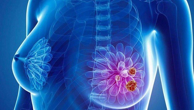 Làm cách nào để phát hiện sớm ung thư vú?