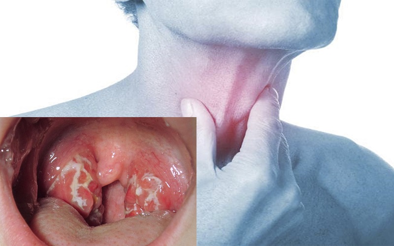 Ung thư vòm họng giai đoạn 2: Sống được bao lâu? Có chữa khỏi được không?