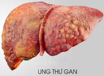 Cần làm gì khi nghi ngờ các triệu chứng của ung thư gan?