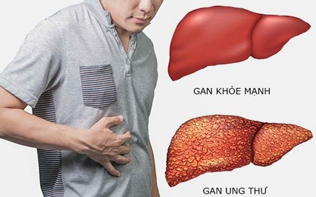 Ung thư gan nên ăn gì? Một số thực phẩm người bệnh nên bổ sung ngay vào thực đơn hàng ngày. 
