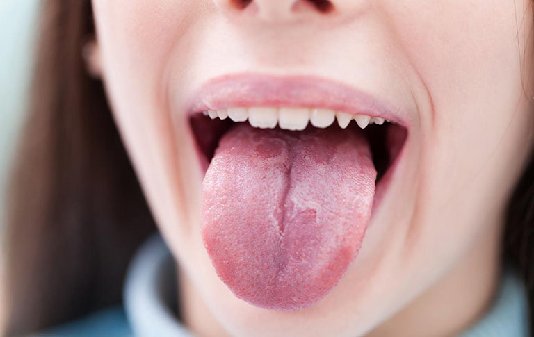 Ung thư lưỡi: 10 dấu hiệu tuyệt đối không nên bỏ qua