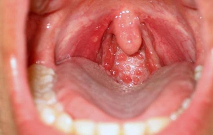 Ung thư vòm họng có lây không? Tìm hiểu ngay để biết