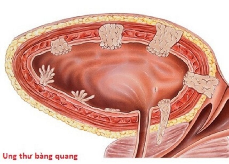 Đối tượng nào có nguy cơ mắc ung thư bàng quang nhất?