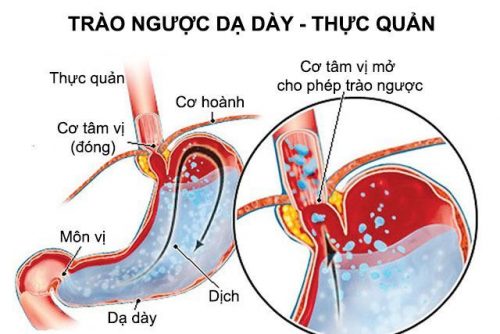trào ngược dạ dày 