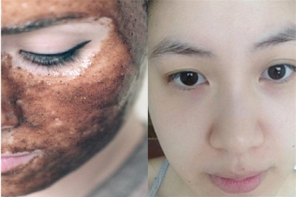 Vì sao chúng ta nên tẩy tế bào chết cho da