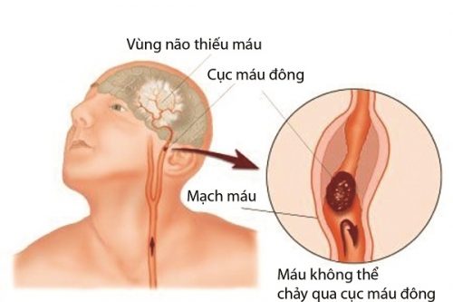 cơn thiếu máu thoảng qua