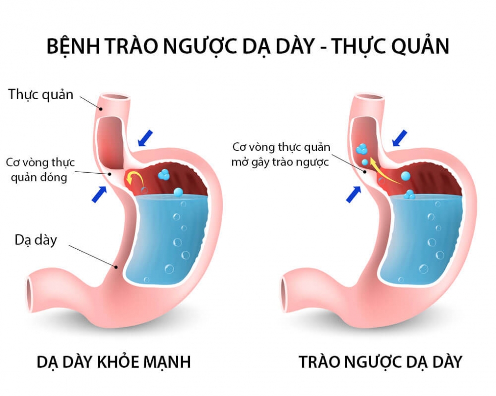 trào ngược dạy dày