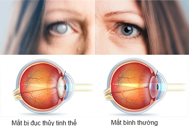 Bị đục thủy tinh thể rất nguy hiểm