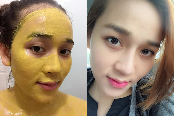Chữa nám da bằng nghệ và mật ong nguyên chất