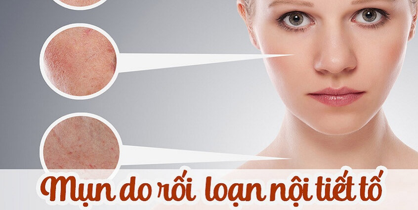 Mụn do rối loạn nội tiết tố