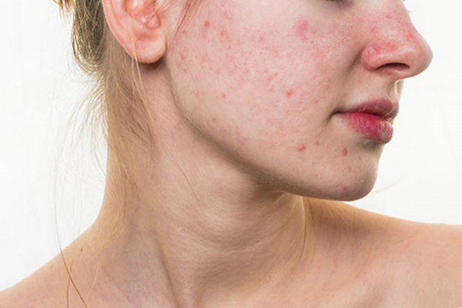 Ăn nhiều dầu mỡ gây nổi mụn