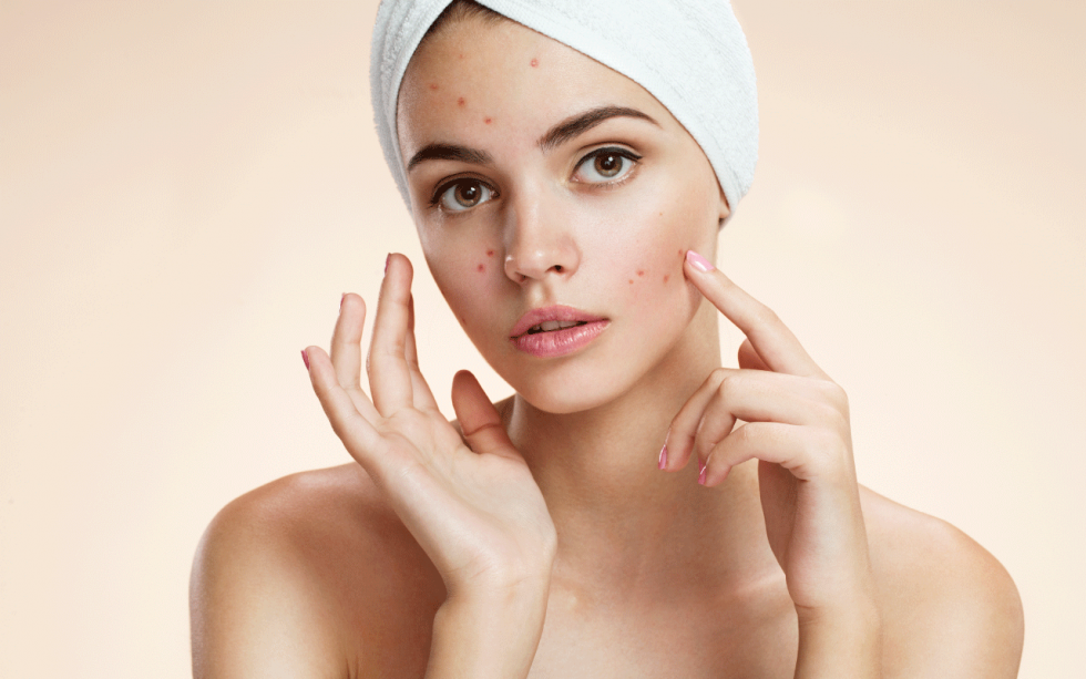 Trị mụn tránh sẹo bằng dầu dừa